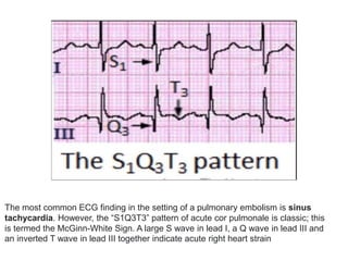11 Pulmonary Embolism 2 pptx 11 Pulmonary Embolism 2 pptx