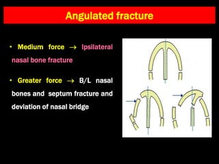 Angulated fracture
• Medium force  Ipsilateral
nasal bone fracture
• Greater force  B/L nasal
bones and septum fracture and
deviation of nasal bridge
 