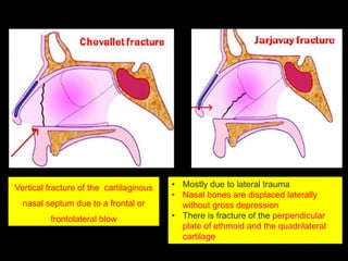 Vertical fracture of the cartilaginous
nasal septum due to a frontal or
frontolateral blow
• Mostly due to lateral trauma
• Nasal bones are displaced laterally
without gross depression
• There is fracture of the perpendicular
plate of ethmoid and the quadrilateral
cartilage
 