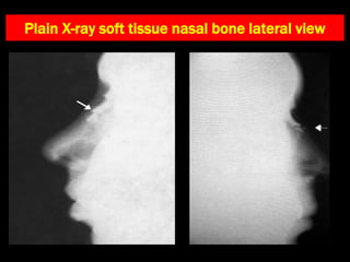 Plain X-ray soft tissue nasal bone lateral view
 
