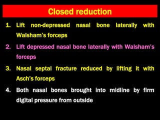 Closed reduction
1. Lift non-depressed nasal bone laterally with
Walsham’s forceps
2. Lift depressed nasal bone laterally with Walsham’s
forceps
3. Nasal septal fracture reduced by lifting it with
Asch’s forceps
4. Both nasal bones brought into midline by firm
digital pressure from outside
 