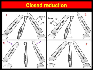 Closed reduction
 