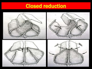 Closed reduction
 