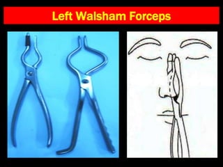 Left Walsham Forceps
 