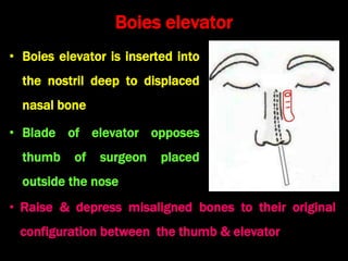 Boies elevator
• Boies elevator is inserted into
the nostril deep to displaced
nasal bone
• Blade of elevator opposes
thumb of surgeon placed
outside the nose
• Raise & depress misaligned bones to their original
configuration between the thumb & elevator
 