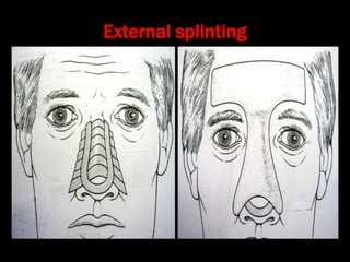 External splinting
 