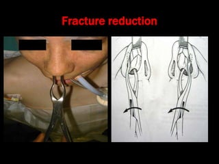 Fracture reduction
 