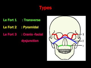 Types
Le Fort 1 : Transverse
Le Fort 2 : Pyramidal
Le Fort 3 : Cranio -facial
dysjunction
 