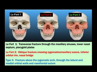 Le Fort 1: Transverse fracture through the maxillary sinuses, lower nasal
septum, pterygoid plates
Le Fort 2: Oblique fracture crossing zygomaticomaxillary suture, inferior
orbital rim, nasal bridge
Type 3: Fracture above the zygomatic arch, through the lateral and
medial orbital walls and nasofrontal suture
Le Fort 3
Le Fort 2
Le Fort 1
 