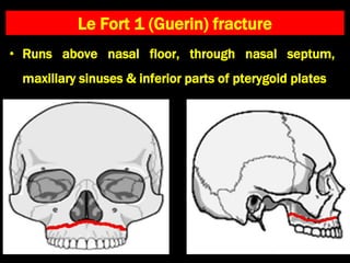 Le Fort 1 (Guerin) fracture
• Runs above nasal floor, through nasal septum,
maxillary sinuses & inferior parts of pterygoid plates
 