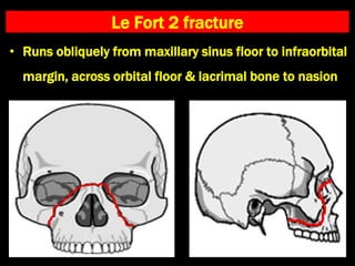 Le Fort 2 fracture
• Runs obliquely from maxillary sinus floor to infraorbital
margin, across orbital floor & lacrimal bone to nasion
 