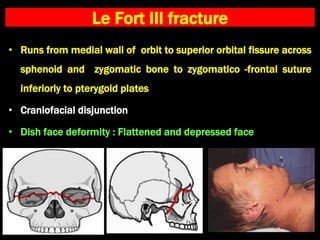 Le Fort III fracture
• Runs from medial wall of orbit to superior orbital fissure across
sphenoid and zygomatic bone to zygomatico -frontal suture
inferiorly to pterygoid plates
• Craniofacial disjunction
• Dish face deformity : Flattened and depressed face
 