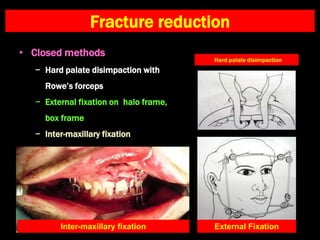 Fracture reduction
• Closed methods
− Hard palate disimpaction with
Rowe’s forceps
− External fixation on halo frame,
box frame
− Inter-maxillary fixation
External Fixation
Inter-maxillary fixation
 