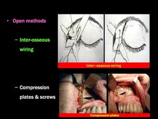 • Open methods
− Inter-osseous
wiring
− Compression
plates & screws
 
