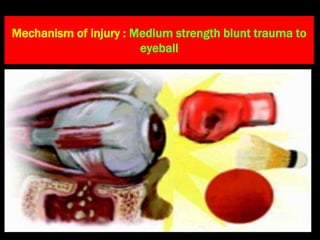 Mechanism of injury : Medium strength blunt trauma to
eyeball
 