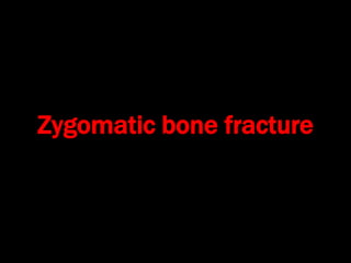 Zygomatic bone fracture
 