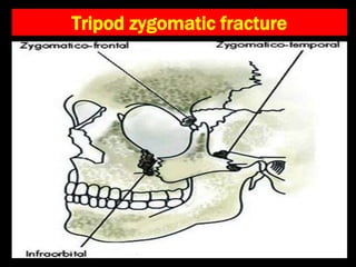Tripod zygomatic fracture
 