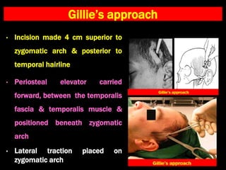 Gillie’s approach
• Incision made 4 cm superior to
zygomatic arch & posterior to
temporal hairline
• Periosteal elevator carried
forward, between the temporalis
fascia & temporalis muscle &
positioned beneath zygomatic
arch
• Lateral traction placed on
zygomatic arch
 