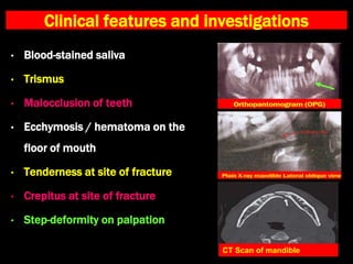 Clinical features and investigations
• Blood-stained saliva
• Trismus
• Malocclusion of teeth
• Ecchymosis / hematoma on the
floor of mouth
• Tenderness at site of fracture
• Crepitus at site of fracture
• Step-deformity on palpation
CT Scan of mandible
 
