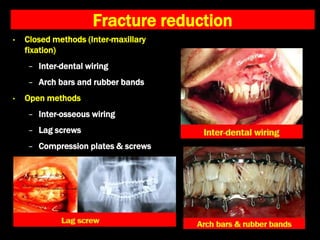 Fracture reduction
• Closed methods (Inter-maxillary
fixation)
− Inter-dental wiring
− Arch bars and rubber bands
• Open methods
− Inter-osseous wiring
− Lag screws
− Compression plates & screws
 