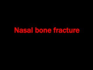 Nasal bone fracture
 