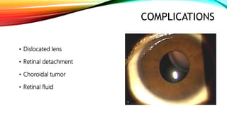 COMPLICATIONS
• Dislocated lens
• Retinal detachment
• Choroidal tumor
• Retinal fluid
 