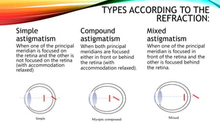 TYPES ACCORDING TO THE
REFRACTION:
Simple
astigmatism
When one of the principal
meridian is focused on
the retina and the other is
not focused on the retina
(with accommodation
relaxed)
Compound
astigmatism
When both principal
meridians are focused
either in front or behind
the retina (with
accommodation relaxed).
Mixed
astigmatism
When one of the principal
meridian is focused in
front of the retina and the
other is focused behind
the retina.
 