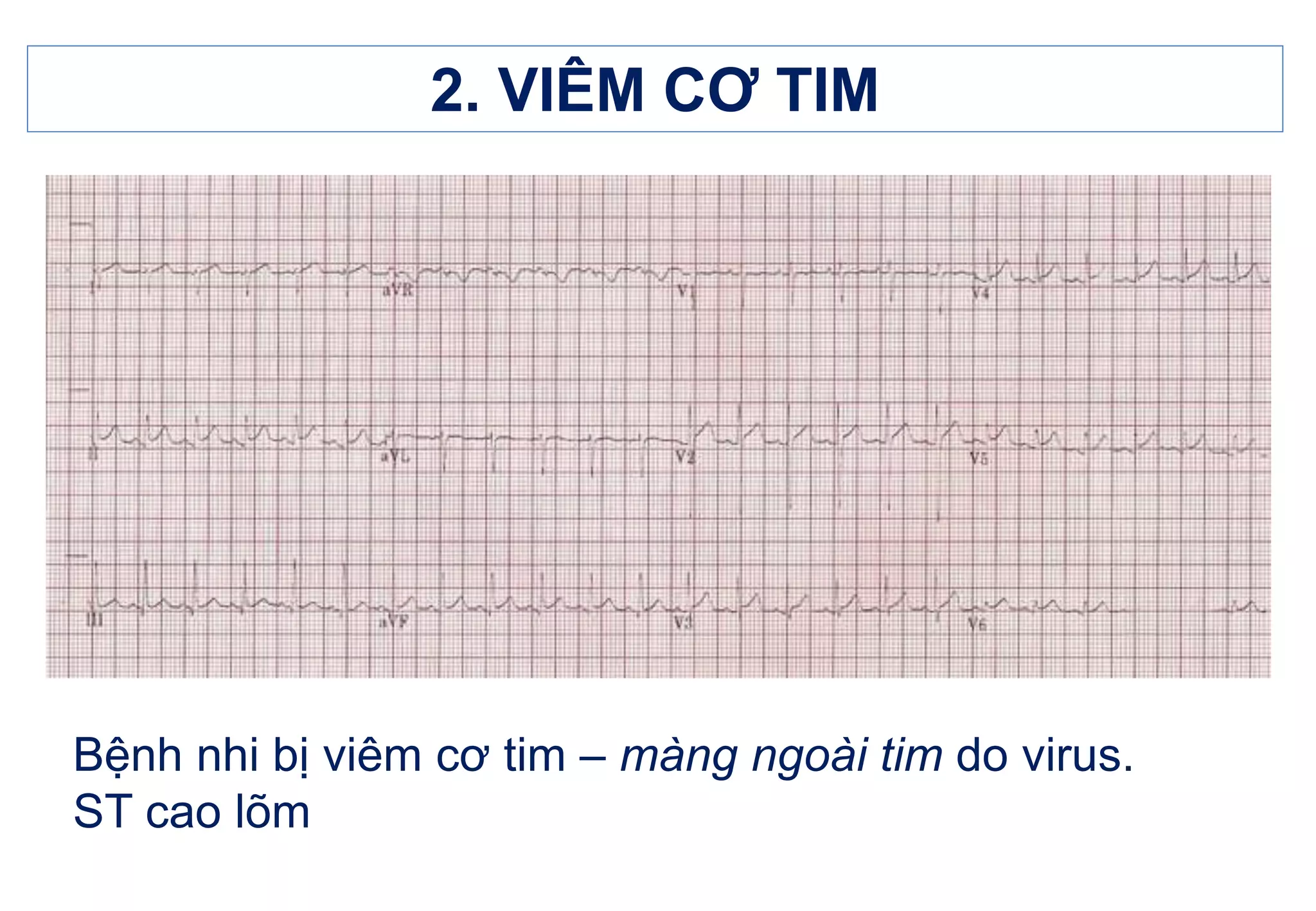 11. ECG VIÊM CƠ TIM - MÀNG NGOÀI TIM.ppt