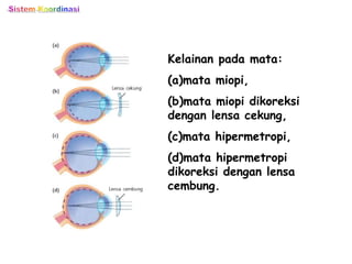 Kelainan pada mata:
(a)mata miopi,
(b)mata miopi dikoreksi
dengan lensa cekung,
(c)mata hipermetropi,
(d)mata hipermetropi
dikoreksi dengan lensa
cembung.
 