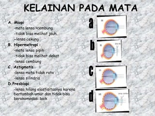 KELAINAN PADA MATA
A. Miopi :
-mata lensa >cembung
-tidak bisa melihat jauh
-lensa cekung
B. Hipermetropi :
-mata lensa pipih
-tidak bisa melihat dekat
-lensa cembung
C. Astigmatis :
-lensa mata tidak rata
-lensa silindris
D.Presbiopi :
-lensa hilang elastisitasnya karena
bertambah umur dan tidak bisa
berakomodasi baik
 