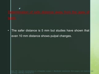 z
Determination of safe distance away from the apex of
teeth:
• The safer distance is 5 mm but studies have shown that
even 10 mm distance shows pulpal changes.
• Epker BN. Vascular considerations in orthognathic surgery: I. Mandibular osteotomies. Oral surgery, oral medicine, oral
pathology. 1984 May 1;57(5):467-72.
 