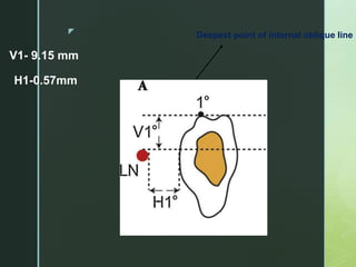 z
H1-0.57mm
Deepest point of internal oblique line
V1- 9.15 mm
 