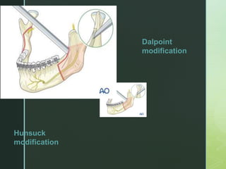 z
Dalpoint
modification
Hunsuck
modification
 