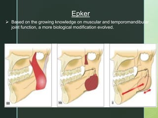  Based on the growing knowledge on muscular and temporomandibular
joint function, a more biological modification evolved.
Epker
 