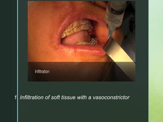 z
1. Infiltration of soft tissue with a vasoconstrictor
1. Infiltration of soft tissue with a
vasoconstrictor
 