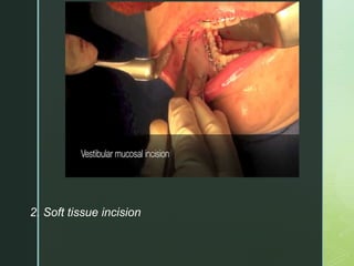 z
2. Soft tissue incision
1. Infiltration of soft tissue with a
vasoconstrictor
 