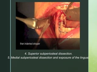 z
4. Superior subperiosteal dissection.
5. Medial subperiosteal dissection and exposure of the lingual.
 