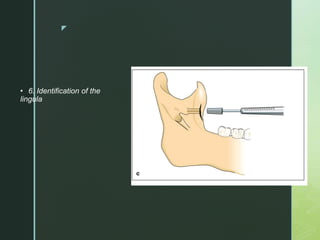 z
• 6. Identification of the
lingula
 