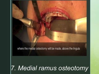 z
7. Medial ramus osteotomy
 