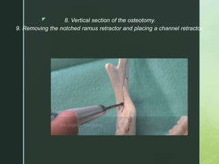 z 8. Vertical section of the osteotomy.
9. Removing the notched ramus retractor and placing a channel retractor.
 