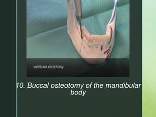 z
10. Buccal osteotomy of the mandibular
body
 