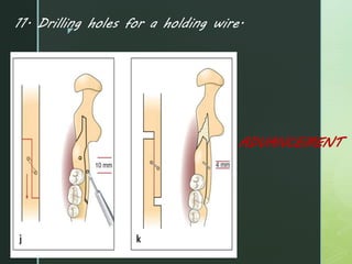 z
11. Drilling holes for a holding wire.
ADVANCEMENT
 