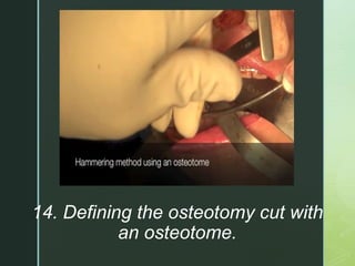 z
14. Defining the osteotomy cut with
an osteotome.
 