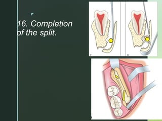 z
16. Completion
of the split.
 