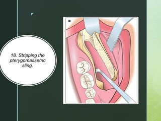 z
18. Stripping the
pterygomassetric
sling.
 