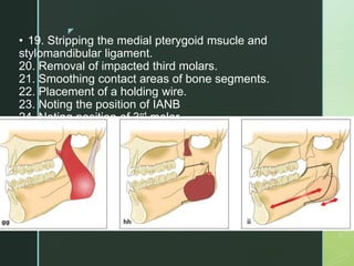 z
• 19. Stripping the medial pterygoid msucle and
stylomandibular ligament.
20. Removal of impacted third molars.
21. Smoothing contact areas of bone segments.
22. Placement of a holding wire.
23. Noting the position of IANB
24. Noting position of 3rd molar.
 