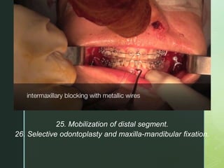 z
25. Mobilization of distal segment.
26. Selective odontoplasty and maxilla-mandibular fixation.
 