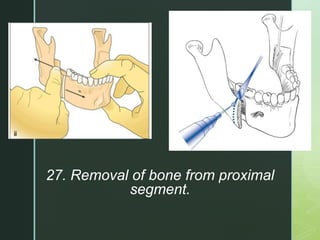 z
27. Removal of bone from proximal
segment.
 