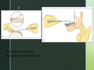z
28. Condylar positioning.
29. Tightening the holding wire
 