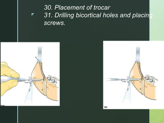 z
30. Placement of trocar
31. Drilling bicortical holes and placing
screws.
 